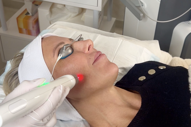 Acne Laser